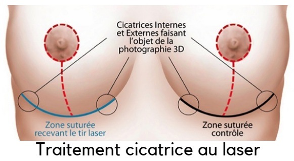 traitement cicatrices seins Tunisie
