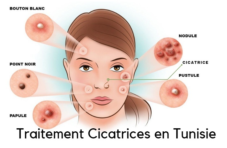 Traitement cicatrice Tunisie